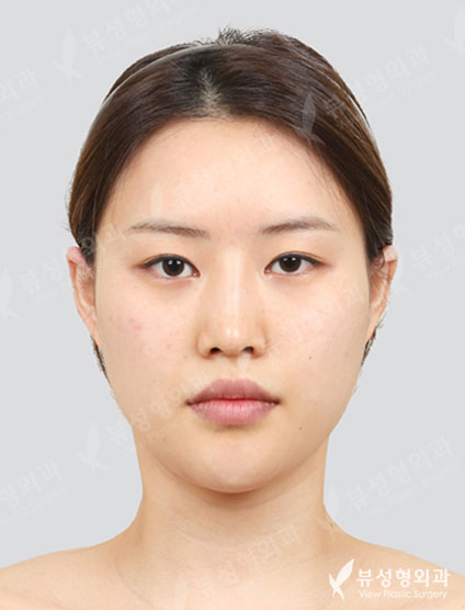 3 Types Face Countouring + Double Eyelid Revisional Surgery + Revisional Rhinoplasty — Before