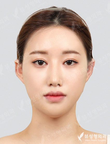 3 Types Face Countouring + Double Eyelid Revisional Surgery + Revisional Rhinoplasty — After