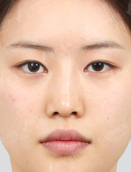 Revisional Rhinoplasty + 3 Types Face Countouring + Double Eyelid Revisional Surgery — Before