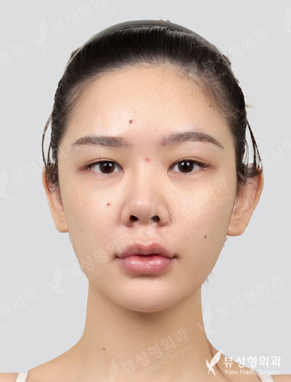 Revisional Rhinoplasty — Before