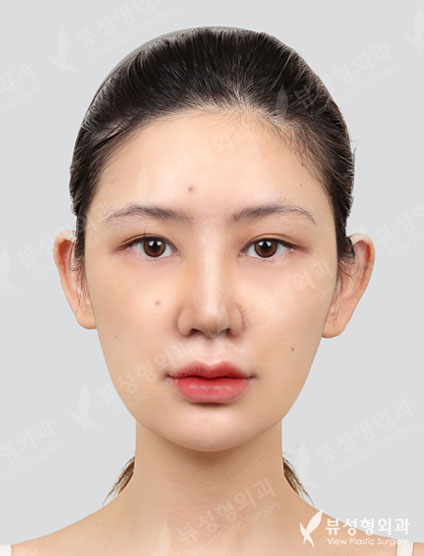 Revisional Rhinoplasty — After