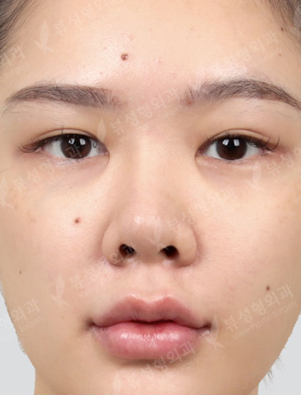 Revisional Rhinoplasty — Before