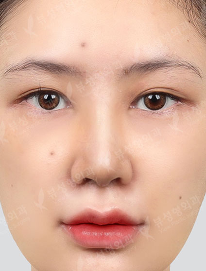 Revisional Rhinoplasty — After
