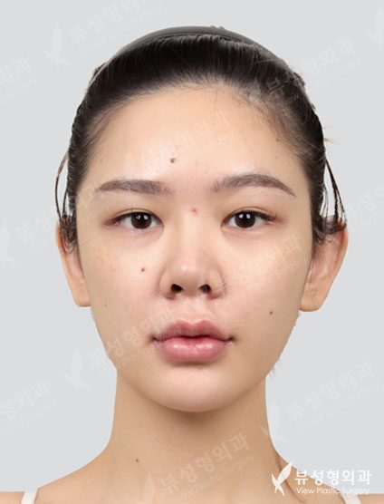 Revisional Rhinoplasty — Before