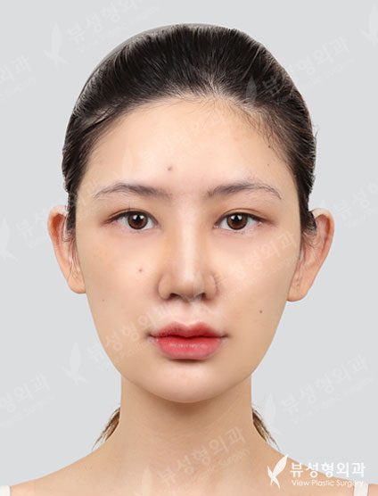 Revisional Rhinoplasty — After