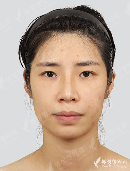 3 Types Face Countouring+Revisional Rhinoplasty+Double Eyelid Revisional Surgery+fat graft surgery (3 Months) — Before