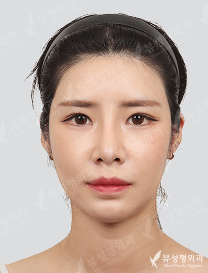 3 Types Face Countouring+Revisional Rhinoplasty+Double Eyelid Revisional Surgery+fat graft surgery (3 Months) — After