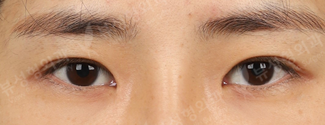Double Eyelid Revisional Surgery+3 Types Face Countouring+Revisional Rhinoplasty+fat graft surgery (3 Months) — Before