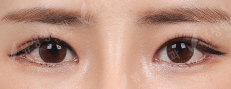 Double Eyelid Revisional Surgery+3 Types Face Countouring+Revisional Rhinoplasty+fat graft surgery (3 Months) — After