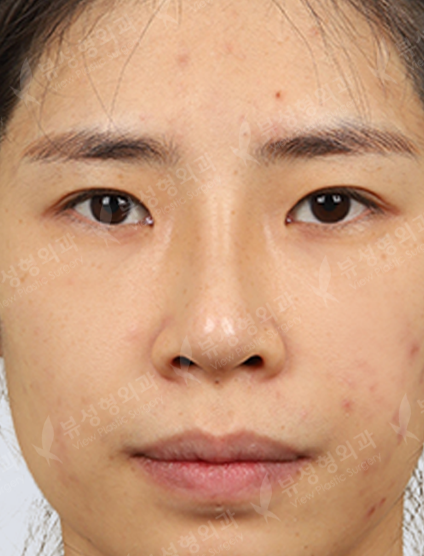 Revisional Rhinoplasty+3 Types Face Countouring+Double Eyelid Revisional Surgery+fat graft surgery (3 Months) — Before
