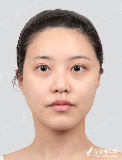3 Types Face Countouring+Rhinoplasty — Before