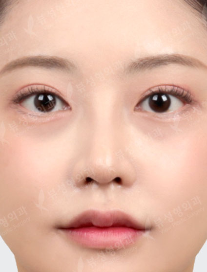 Rhinoplasty +3 Types Face Countouring — After