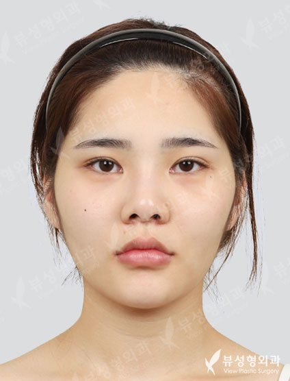3 Types Face Countouring+Double Eyelid Revisional Surgery (3 Months) — Before