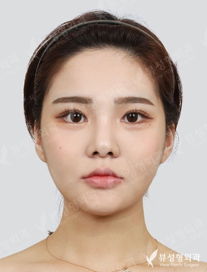 3 Types Face Countouring+Double Eyelid Revisional Surgery (3 Months) — After