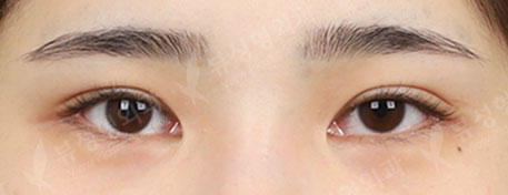 Double Eyelid Revisional Surgery+3 Types Face Countouring (3 Months) — Before