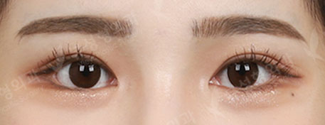 Double Eyelid Revisional Surgery+3 Types Face Countouring (3 Months) — After