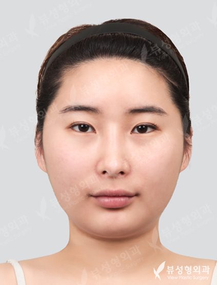 3 Types Face Countouring, Lateral Canthoplasty, Lower Canthoplasty — Before