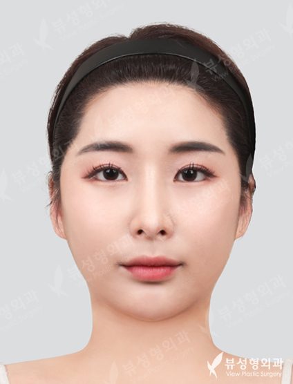 3 Types Face Countouring, Lateral Canthoplasty, Lower Canthoplasty — After