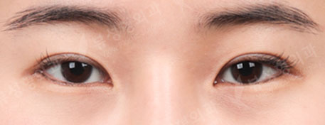 Lateral Canthoplasty, Lower Canthoplasty — Before