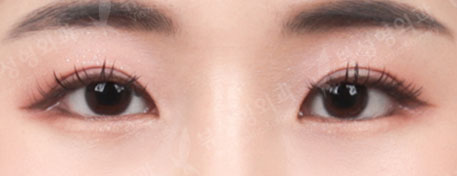 Lateral Canthoplasty, Lower Canthoplasty — After
