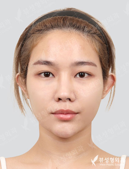 3 Types Face Countouring+Revisional Rhinoplasty — Before