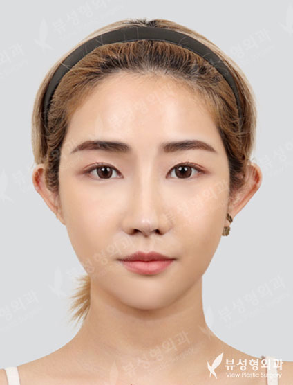 3 Types Face Countouring+Revisional Rhinoplasty — After