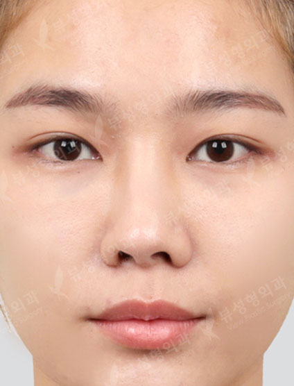 Revisional Rhinoplasty+3 Types Face Countouring — Before