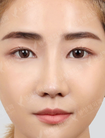 Revisional Rhinoplasty+3 Types Face Countouring — After