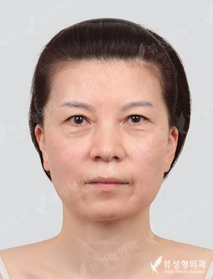 Forehead lifting + double eyelid surgery (non-incision, lower blephaloplasty) — Before