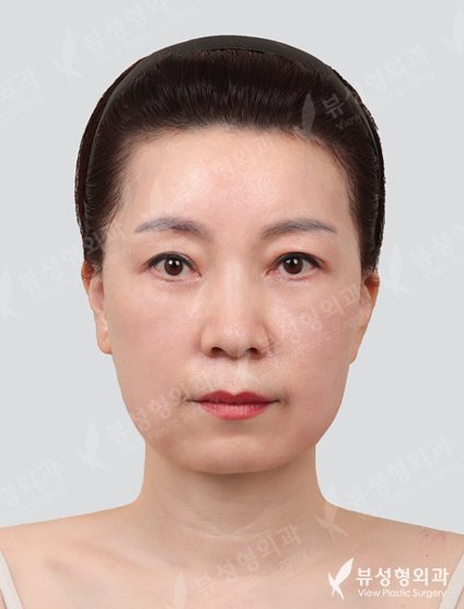 Forehead lifting + double eyelid surgery (non-incision, lower blephaloplasty) — After