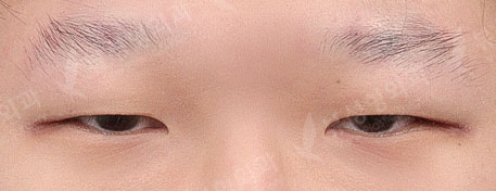 incisional double eyelid surgery+ptosis correction+epicanthoplasty — Before