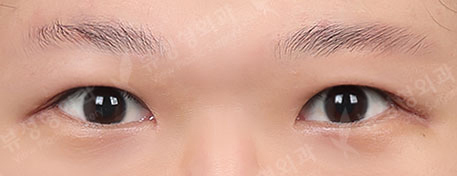 incisional double eyelid surgery+ptosis correction+epicanthoplasty — After