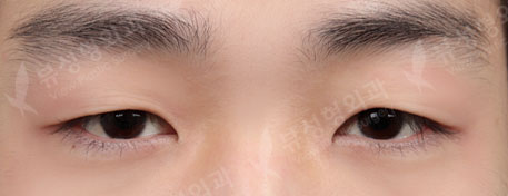 non-incisional double eyelid surgery+ptosis correction+eyelid fat removal — Before