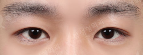 non-incisional double eyelid surgery+ptosis correction+eyelid fat removal — After
