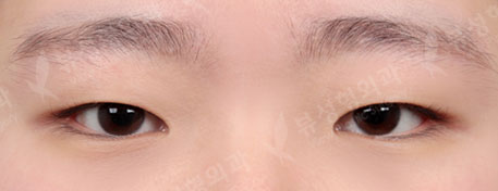 incisional double eyelid surgery+ptosis correction+epicanthoplasty+eyelid fat removal — Before