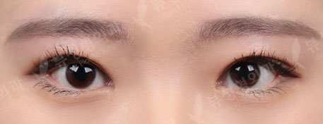 incisional double eyelid surgery+ptosis correction+epicanthoplasty+eyelid fat removal — After