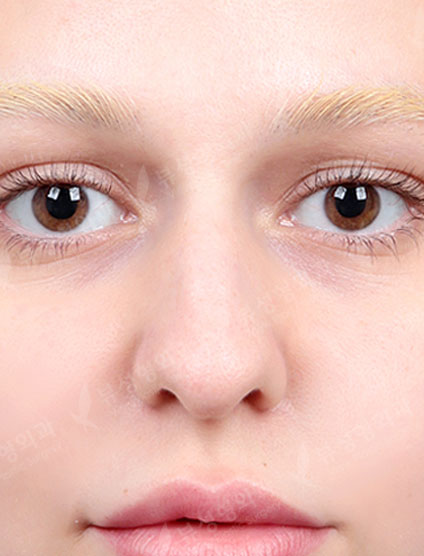 Rhinoplasty — Before