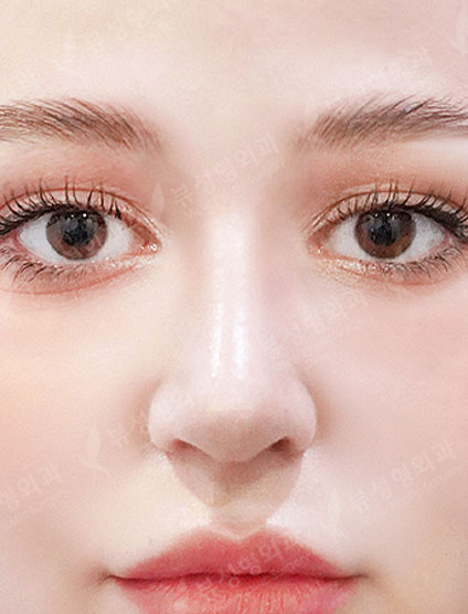 Rhinoplasty — After