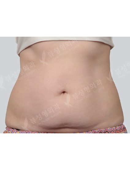 Liposuction abdomen — Before