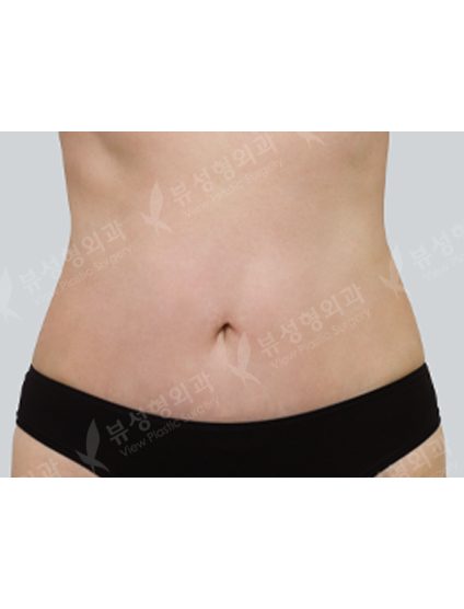 Liposuction abdomen — After
