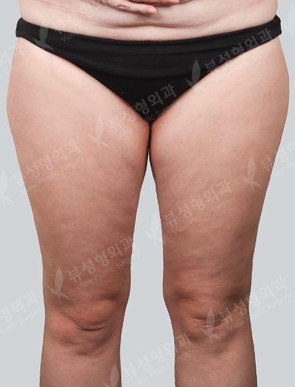 Liposuction Thigh — Before