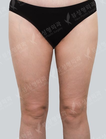 Liposuction Thigh — After