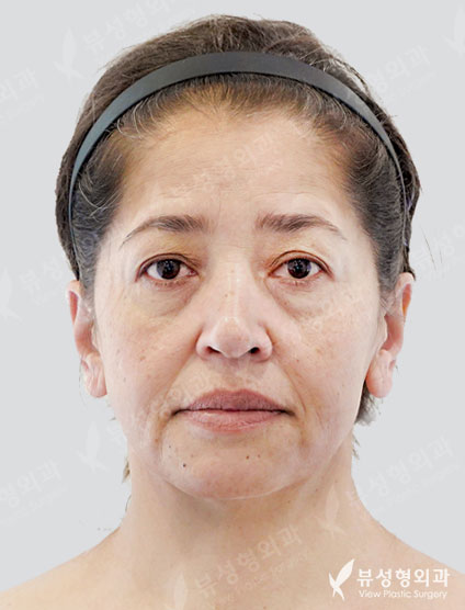 Endotine+Face Lift+Neck Lifting+Brow lift+Lower blepharoplasty — Before