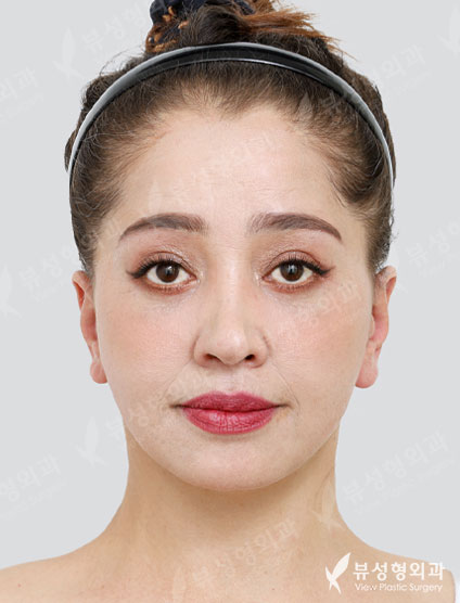 Endotine+Face Lift+Neck Lifting+Brow lift+Lower blepharoplasty — After