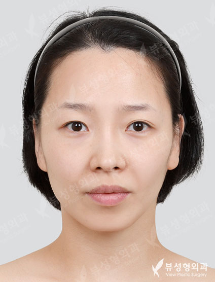 3 Types Face Countouring + Thread Lift — Before