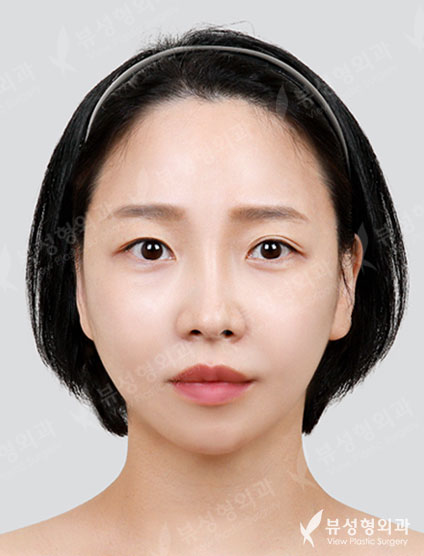 3 Types Face Countouring + Thread Lift — After