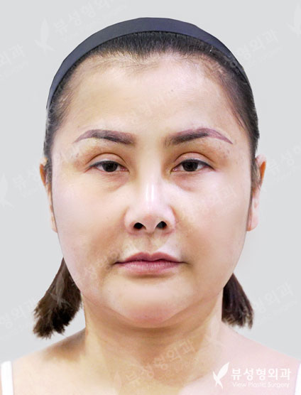 lower blepharoplasty + face&neck lift + Liposuction (double chin) — Before