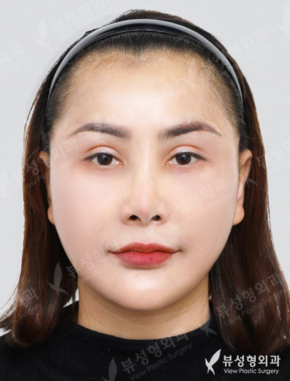 lower blepharoplasty + face&neck lift + Liposuction (double chin) — After