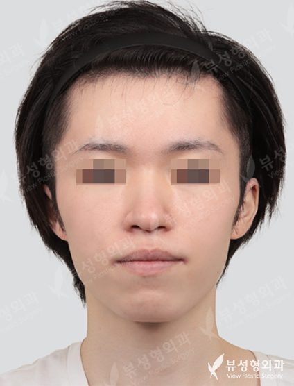 3 Types Face Countouring+Rhinoplasty — Before