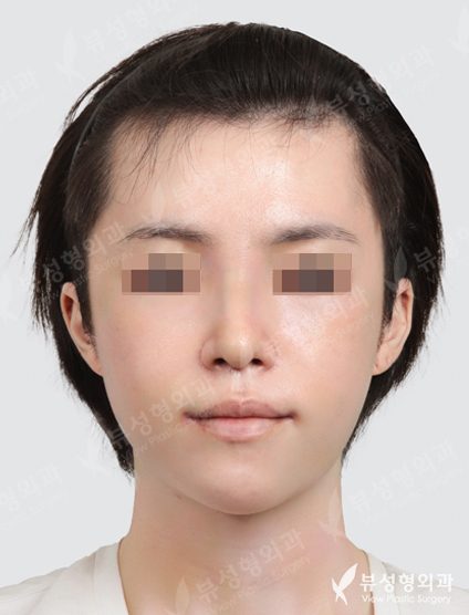 3 Types Face Countouring+Rhinoplasty — After